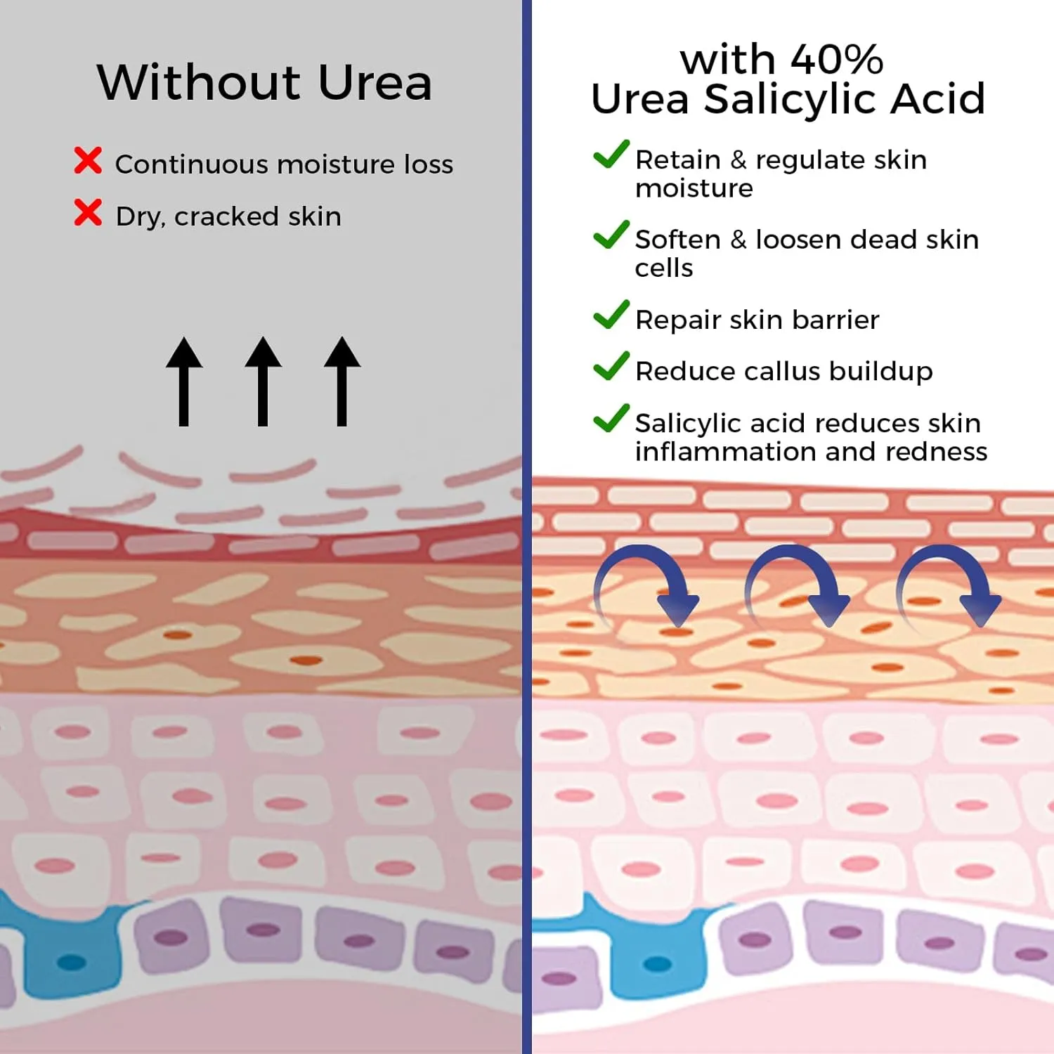 OUKEYA Urea Cream 42% plus Salicylic Acid 2% Intensive Repair Treatment for Cracked Skin on Hands, Heels, Elbows, and Lips - Relief for Dry Feet - Enhanced Pump Dispenser Packaging 2 Pack