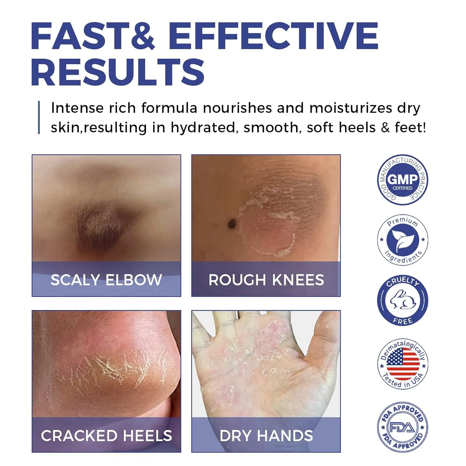 OUKEYA Urea Cream 42% plus Salicylic Acid 2% Intensive Repair Treatment for Cracked Skin on Hands, Heels, Elbows, and Lips - Relief for Dry Feet - Enhanced Pump Dispenser Packaging 2 Pack